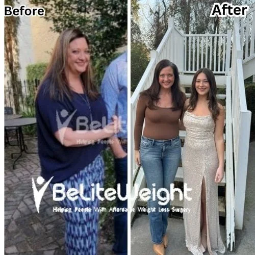 Gastric Sleeve Surgery Before and After Jennifer L - 1 Year Update*